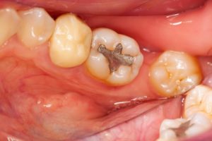 "silver" mercury dental fillings mercury dental fillings - Depositphotos 14032282 original 300x200 - Mercury dental fillings linked to many chronic illnesses