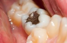 Increased mercury emissions from modern dental amalgam fillings