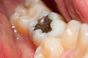 Mercury Dental Amalgam Filling amalgam - amalgam tooth filling in mouth 300x200 - Increased mercury emissions from modern dental amalgam fillings