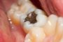 Increased mercury emissions from modern dental amalgam fillings  - amalgam tooth filling in mouth 90x60 - suzuki GSF indicator